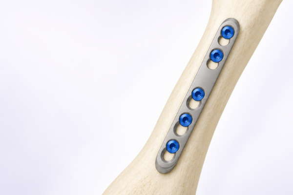 Visualización ilustrativa de un sistema de osteosíntesis